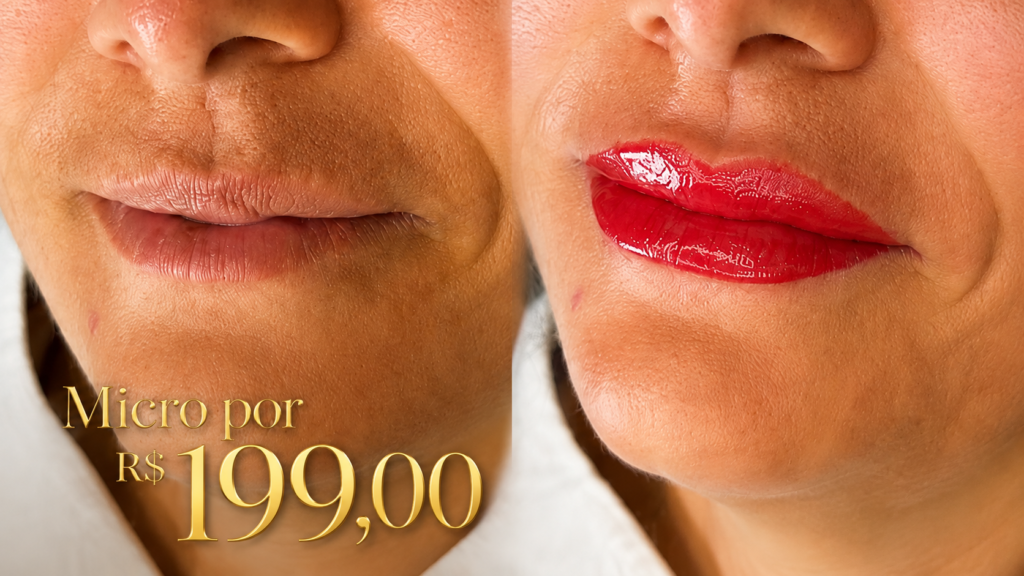 Quanto custa micro labial em Porto Alegre? Quanto custa micro labial em Porto Alegre?